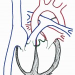 Aortic Valve Stenosis Aortic Valve Stenosis